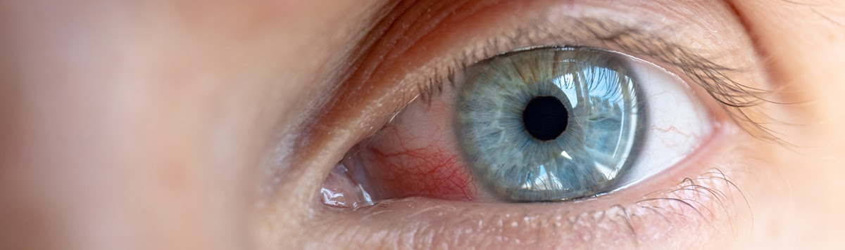 Аллергический конъюнктивит